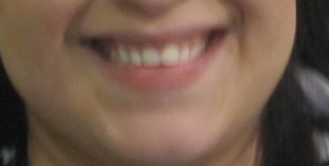 smile makeover in houston tx