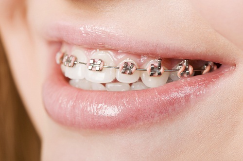 Traditional Braces Houston, TX, Orthodontics