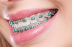 Affordable braces in Houston